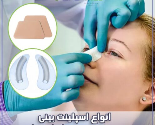 انواع اسپلینت بینی